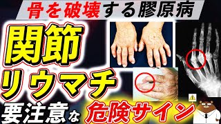 【危険】知らないと後悔する「リウマチ」が引き起こす体の変化。眼・皮ふ・指..初期の危険サインとは？予防法とは？医師が徹底解説！