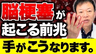 【”隠れ”脳梗塞のサイン】手が〇〇の人は今すぐ気をつけて！40代以上は絶対知っておくべき血管の新常識