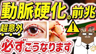 【危険】知らないと後悔する。目・首・足..全身で動脈硬化が進行すると起きる要注意な危険サイン。血管が詰まる寸前必ずこうなる。動脈硬化を防ぐ術はないのか。医師が完全解説。