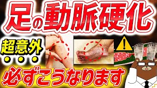 【危険】知らないと後悔する。がんより死亡率が高い「足の動脈硬化」の要注意な危険サイン。進行すると起きる初期症状とは？足は第二の心臓。足の血管を守るためにできるお手軽な予防法は？医師が完全解説。